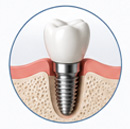 Oro-Dental Implants